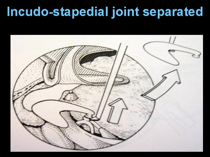 Incudo-stapedial joint separated Incudo-stapedial joint separated