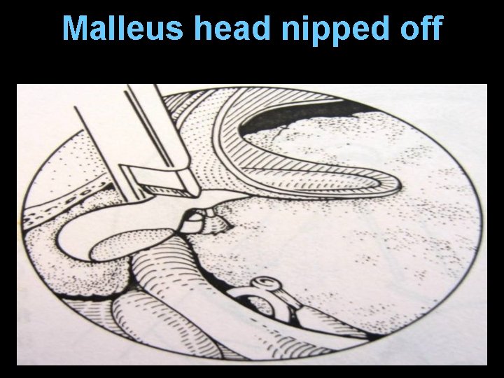 Malleus head nipped off Malleus head nipped off