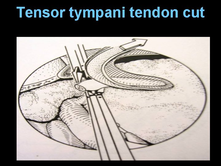 Tensor tympani tendon cut Tensor tympani tendon cut