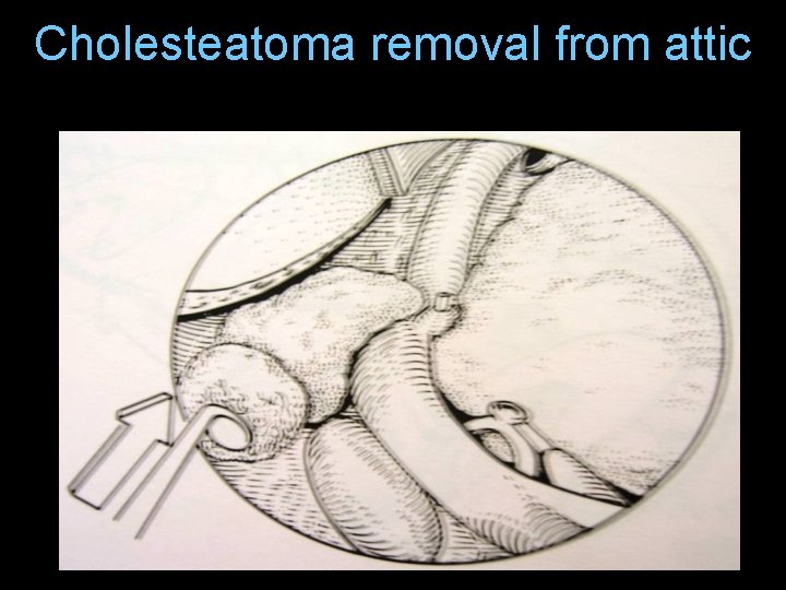 Cholesteatoma removal from attic Cholesteatoma removal from attic
