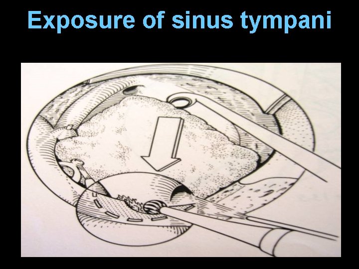 Exposure of sinus tympani Exposure of sinus tympani