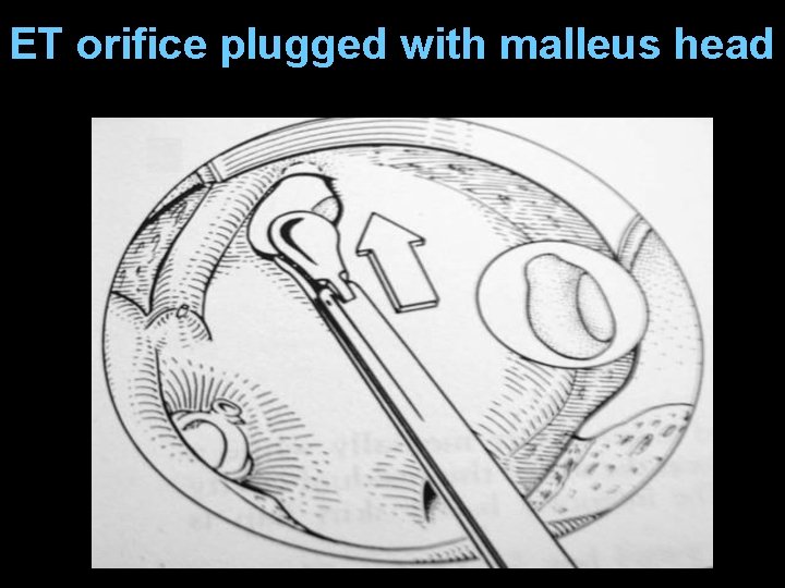 ET orifice plugged with malleus head ET orifice plugged with malleus head