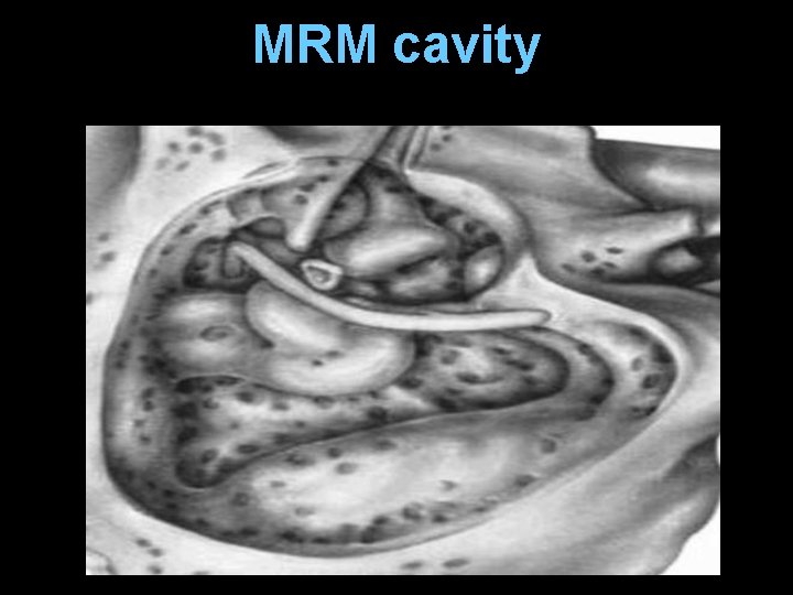 MRM cavity MRM cavity