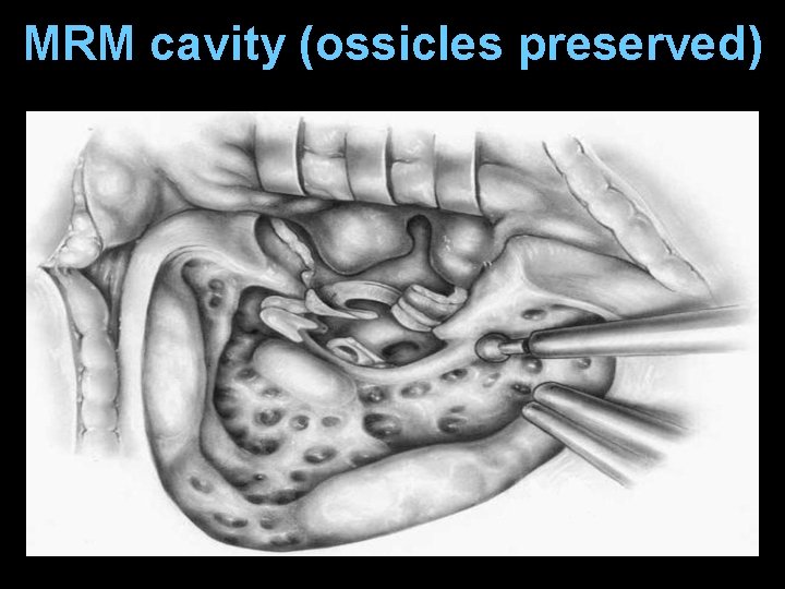 MRM cavity (ossicles preserved) MRM cavity (ossicles preserved)