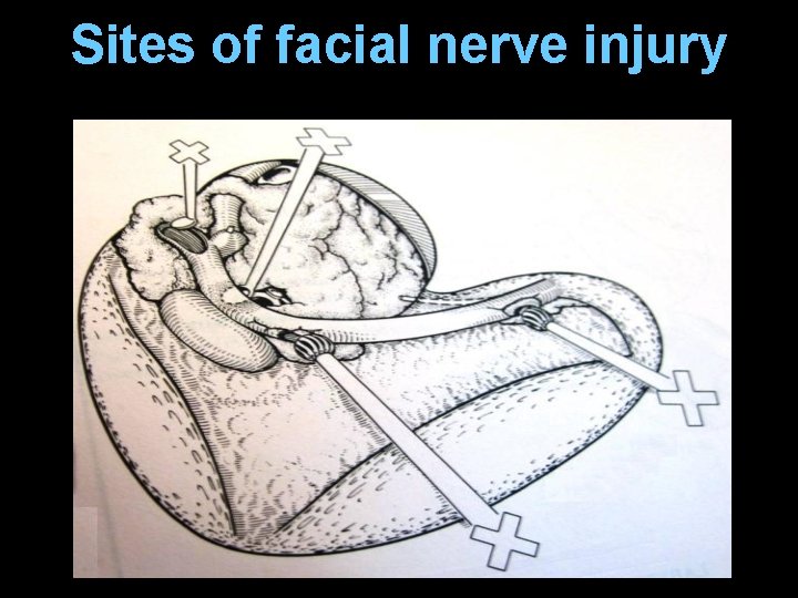 Sites of facial nerve injury Sites of facial nerve injury