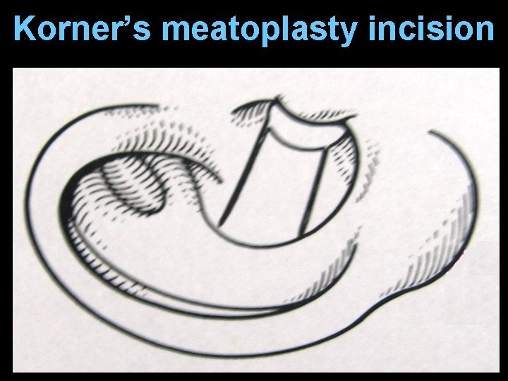 Korner’s meatoplasty incision Korner’s meatoplasty incision