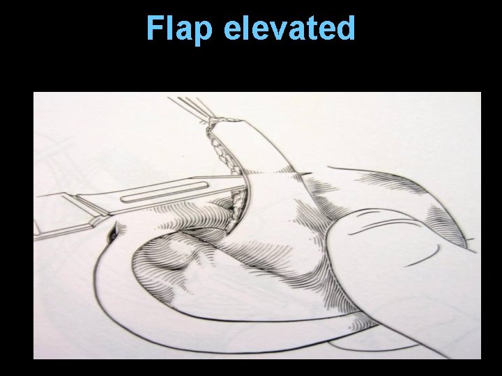 Flap elevated Flap elevated