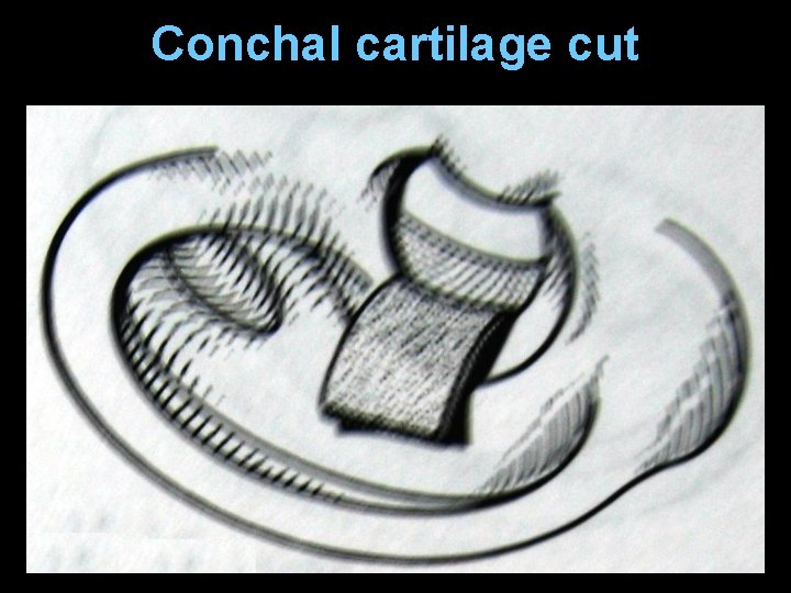 Conchal cartilage cut Conchal cartilage cut