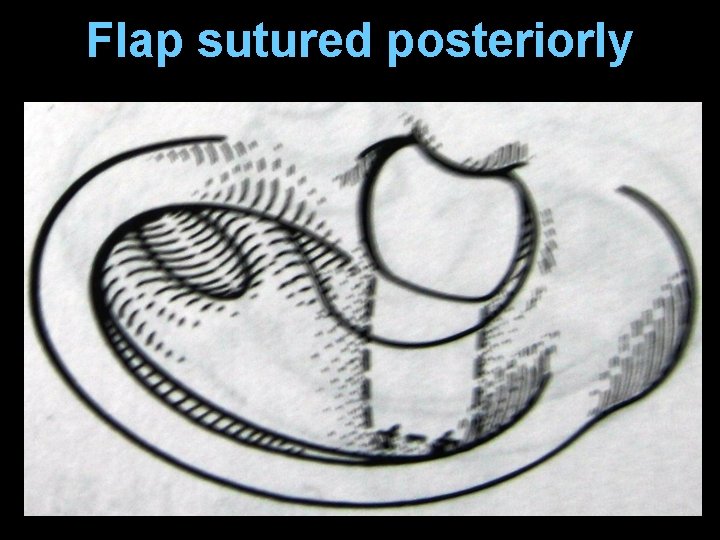 Flap sutured posteriorly Flap sutured posteriorly