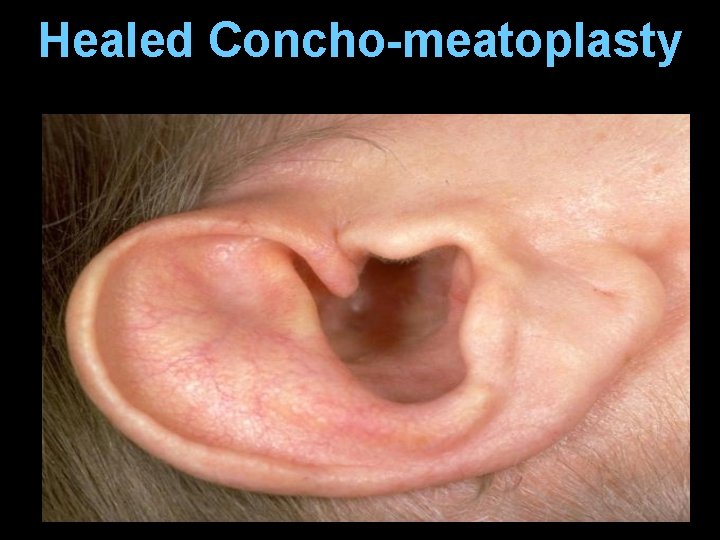 Healed Concho-meatoplasty Healed Concho-meatoplasty
