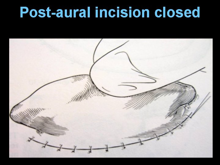 Post-aural incision closed Post-aural incision closed