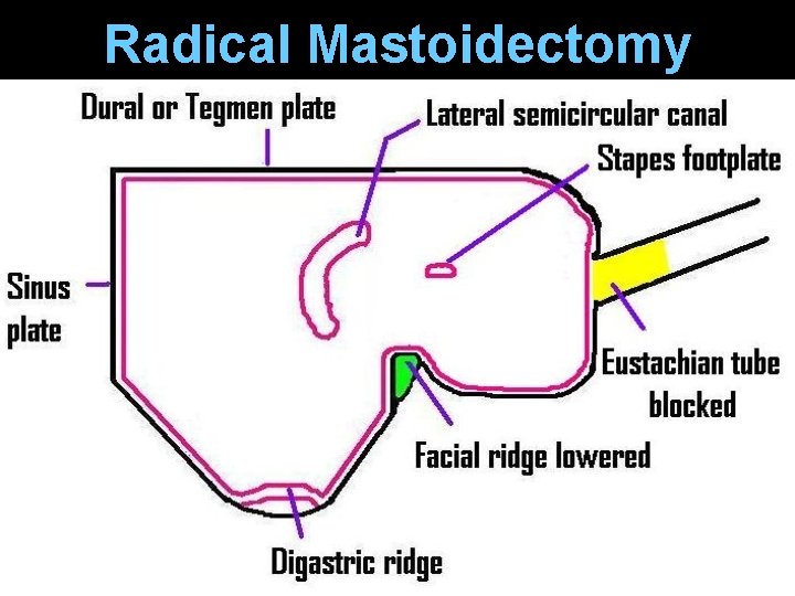 Radical Mastoidectomy Radical Mastoidectomy