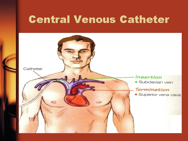 Central Venous Catheter 