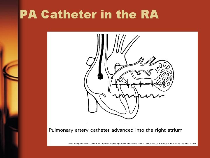 PA Catheter in the RA 