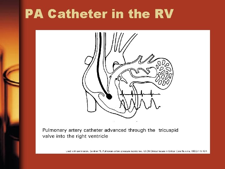 PA Catheter in the RV 