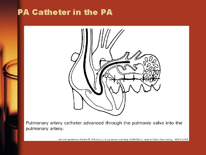 PA Catheter in the PA 