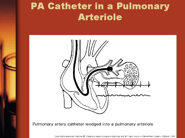 PA Catheter in a Pulmonary Arteriole 