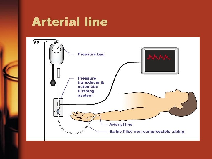 Arterial line 
