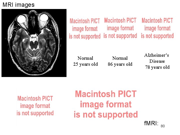 MRI images Normal 25 years old Normal 86 years old Alzheimer’s Disease 78 years