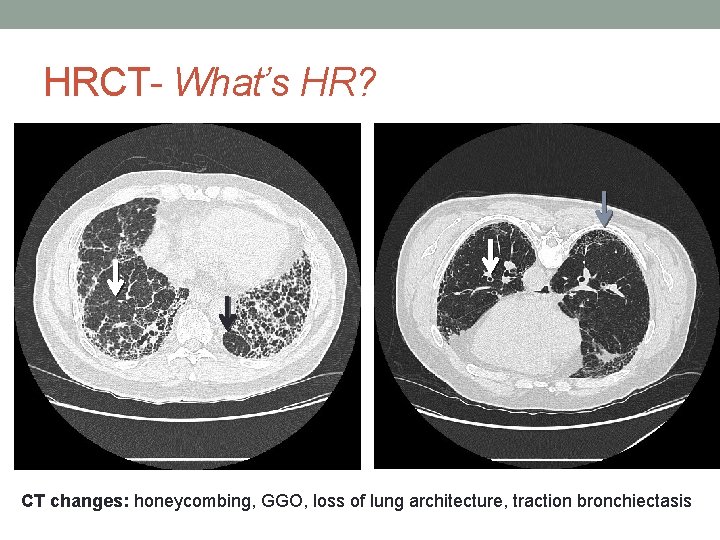 HRCT- What’s HR? CT changes: honeycombing, GGO, loss of lung architecture, traction bronchiectasis 