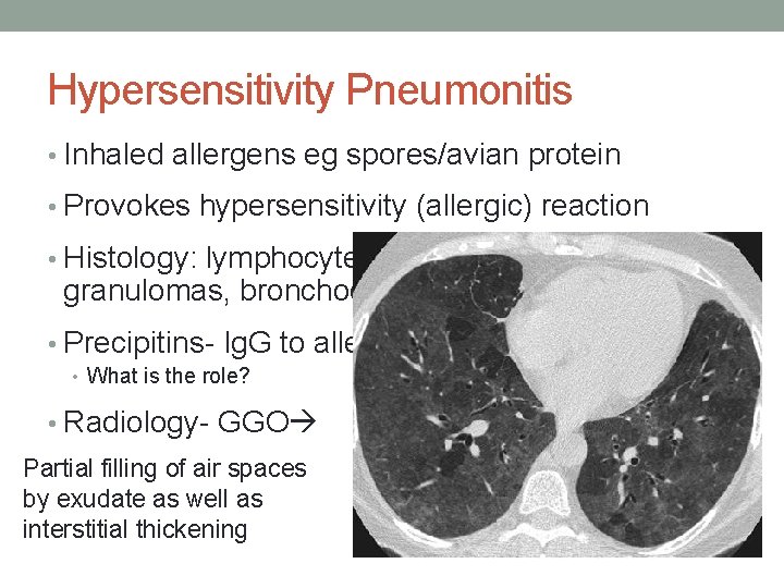 Hypersensitivity Pneumonitis • Inhaled allergens eg spores/avian protein • Provokes hypersensitivity (allergic) reaction •