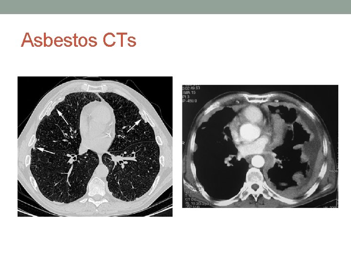 Asbestos CTs 