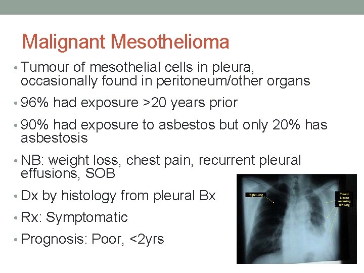 Malignant Mesothelioma • Tumour of mesothelial cells in pleura, occasionally found in peritoneum/other organs