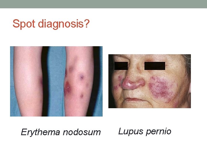 Spot diagnosis? Erythema nodosum Lupus pernio 