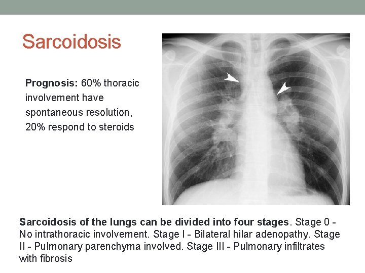 Sarcoidosis Prognosis: 60% thoracic involvement have spontaneous resolution, 20% respond to steroids Sarcoidosis of