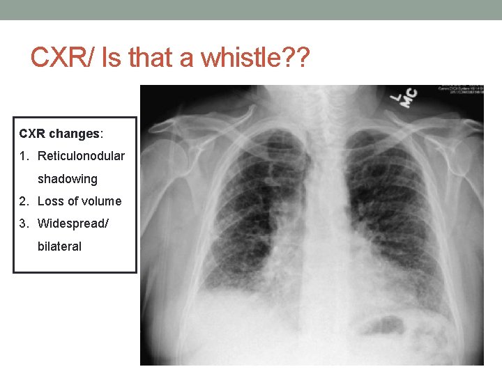 CXR/ Is that a whistle? ? CXR changes: 1. Reticulonodular shadowing 2. Loss of