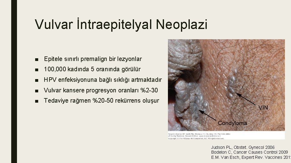 Vulvar İntraepitelyal Neoplazi ■ Epitele sınırlı premalign bir lezyonlar ■ 100, 000 kadında 5 Vulvar İntraepitelyal Neoplazi ■ Epitele sınırlı premalign bir lezyonlar ■ 100, 000 kadında 5