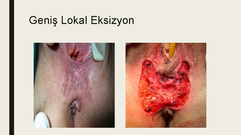 Geniş Lokal Eksizyon Geniş Lokal Eksizyon