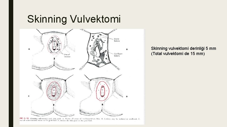 Skinning Vulvektomi Skinning vulvektomi derinliği 5 mm (Total vulvektomi de 15 mm) Skinning Vulvektomi Skinning vulvektomi derinliği 5 mm (Total vulvektomi de 15 mm)