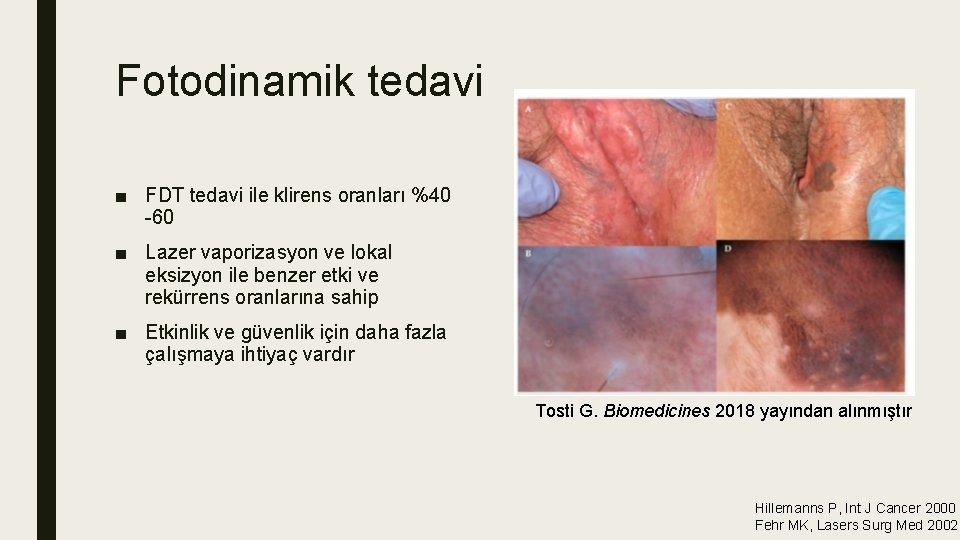 Fotodinamik tedavi ■ FDT tedavi ile klirens oranları %40 -60 ■ Lazer vaporizasyon ve Fotodinamik tedavi ■ FDT tedavi ile klirens oranları %40 -60 ■ Lazer vaporizasyon ve