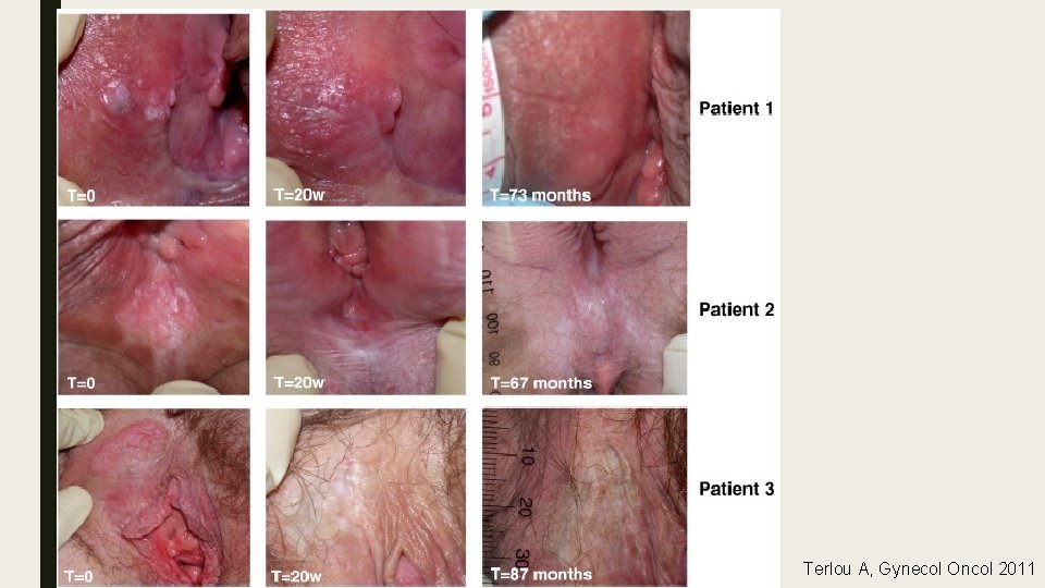 Terlou A, Gynecol Oncol 2011 Terlou A, Gynecol Oncol 2011