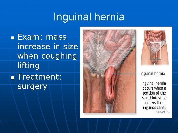 Inguinal hernia n n Exam: mass increase in size when coughing or lifting Treatment: