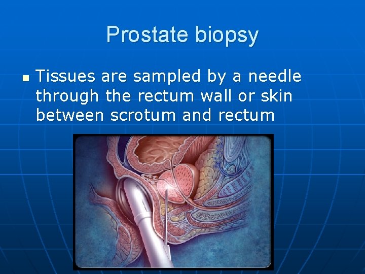 Prostate biopsy n Tissues are sampled by a needle through the rectum wall or