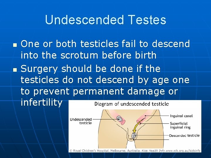 Undescended Testes n n One or both testicles fail to descend into the scrotum