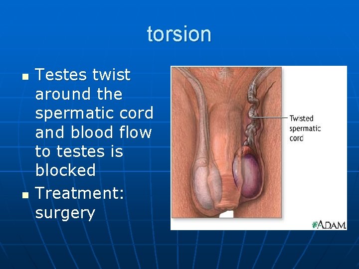 torsion n n Testes twist around the spermatic cord and blood flow to testes