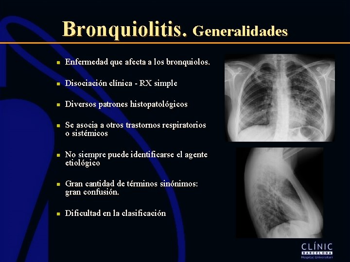 Bronquiolitis. Generalidades n Enfermedad que afecta a los bronquiolos. n Disociación clínica - RX