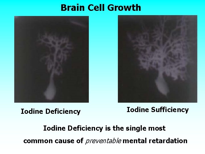 Brain Cell Growth Iodine Deficiency Iodine Sufficiency Iodine Deficiency is the single most common