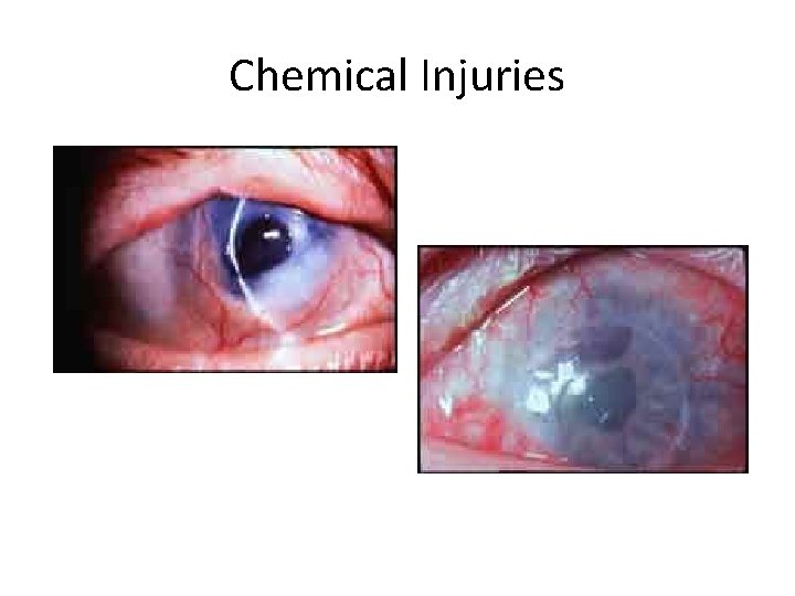 Chemical Injuries 