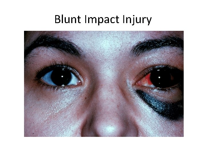 Blunt Impact Injury 