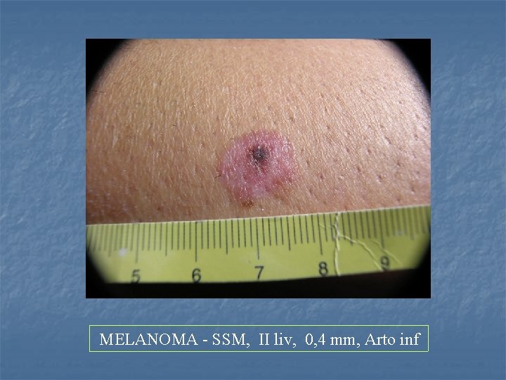 MELANOMA - SSM, II liv, 0, 4 mm, Arto inf 