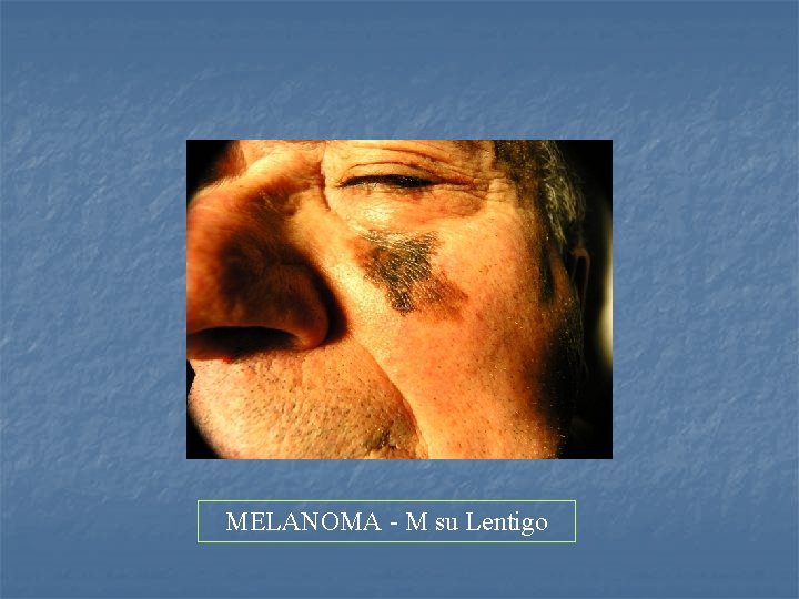 MELANOMA - M su Lentigo 