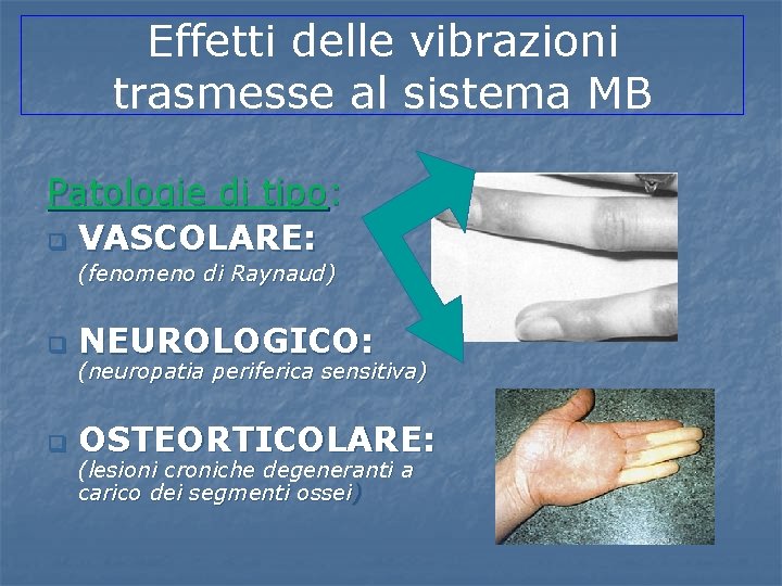 Effetti delle vibrazioni trasmesse al sistema MB Patologie di tipo: q VASCOLARE: (fenomeno di