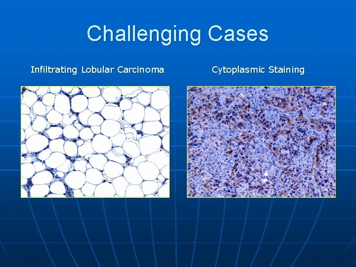 Challenging Cases Infiltrating Lobular Carcinoma Cytoplasmic Staining 