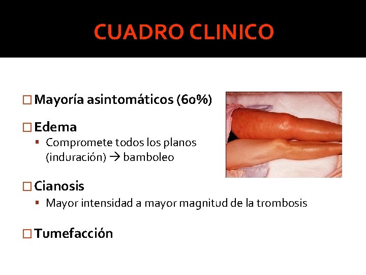 CUADRO CLINICO � Mayoría asintomáticos (60%) � Edema Compromete todos los planos (induración) bamboleo