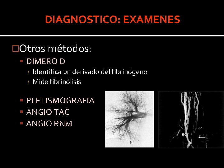 DIAGNOSTICO: EXAMENES �Otros métodos: DIMERO D ▪ Identifica un derivado del fibrinógeno ▪ Mide