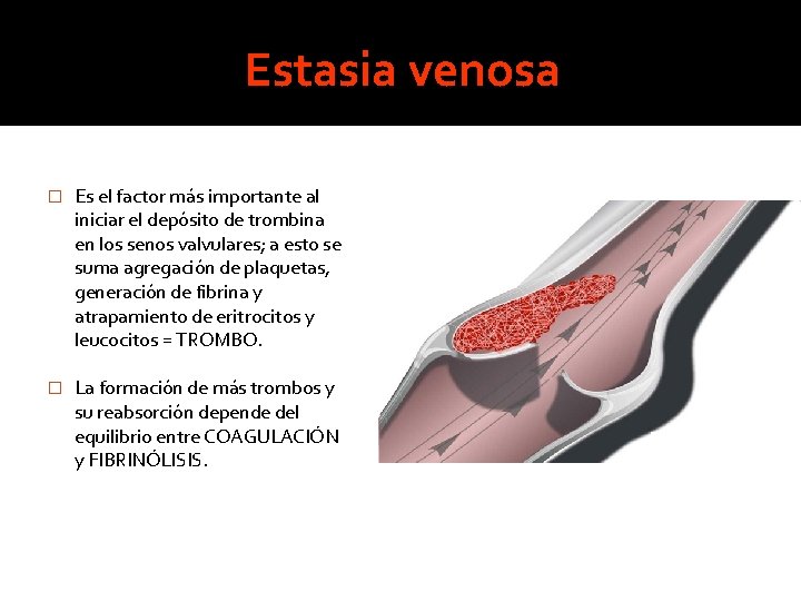 Estasia venosa � Es el factor más importante al iniciar el depósito de trombina